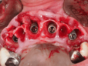Masterclass : Extraction-Implantation Immédiate – Maîtriser le Timing et la Précision Chirurgicale