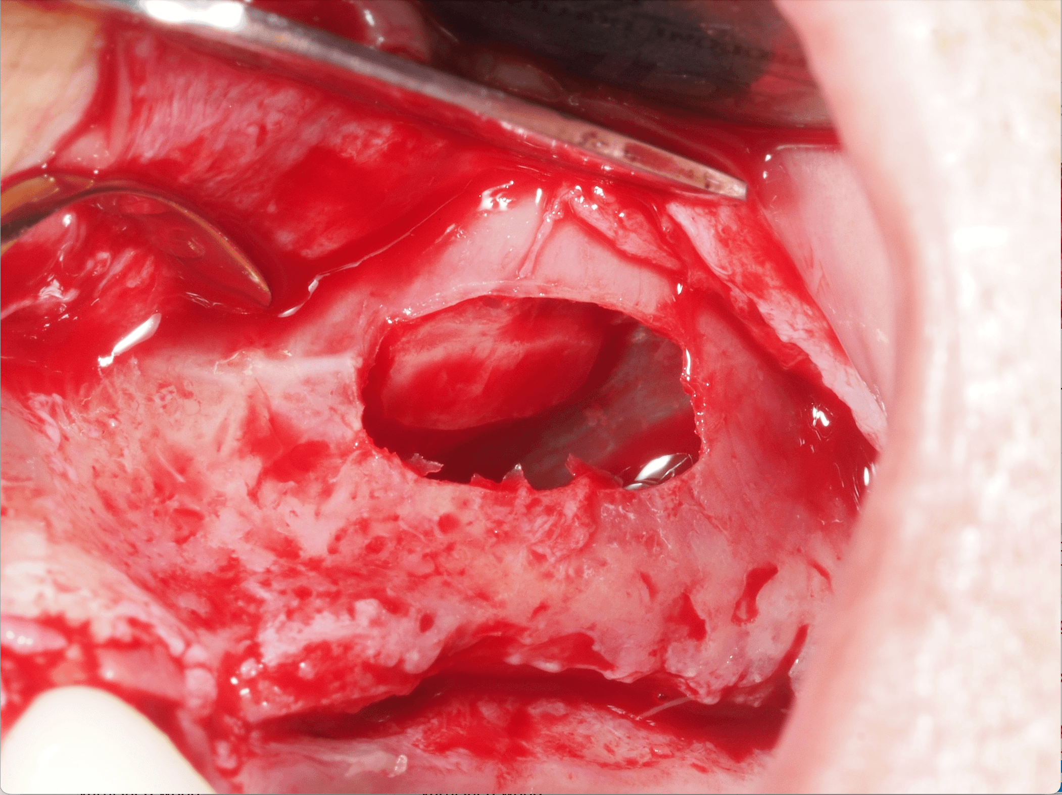 Masterclass : Greffes de Sinus – Sinus Lift et Techniques Avancées de Reconstruction Osseuse