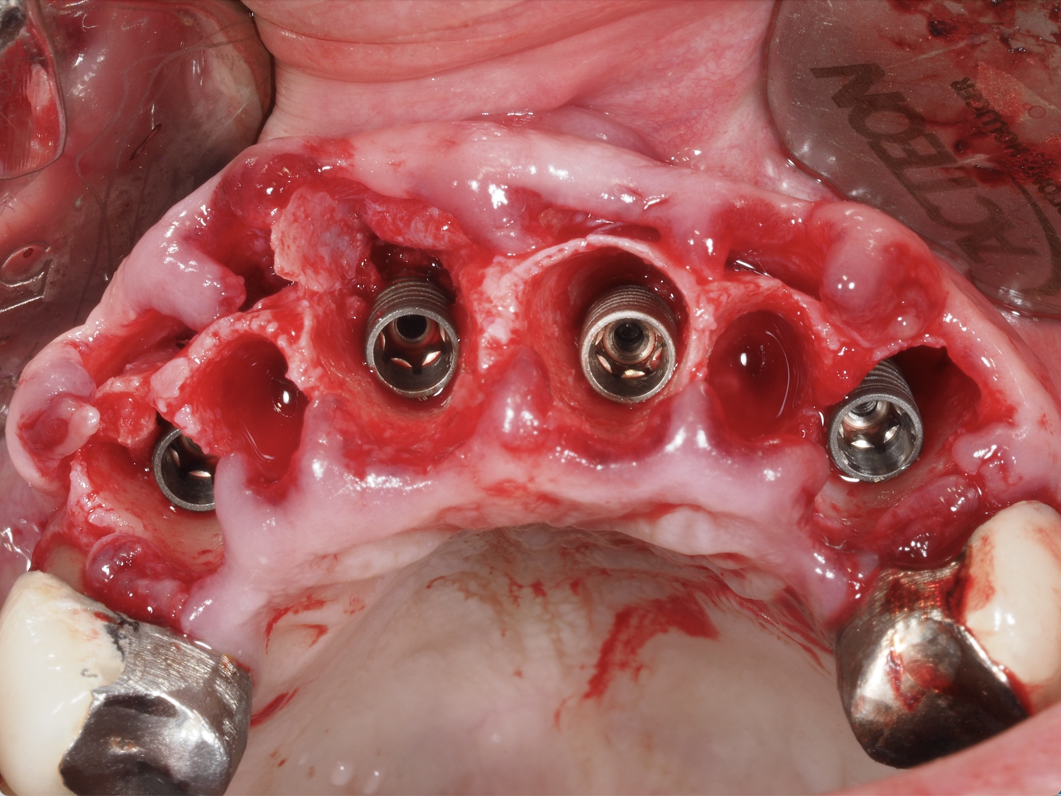 Masterclass : Extraction-Implantation Immédiate – Maîtriser le Timing et la Précision Chirurgicale