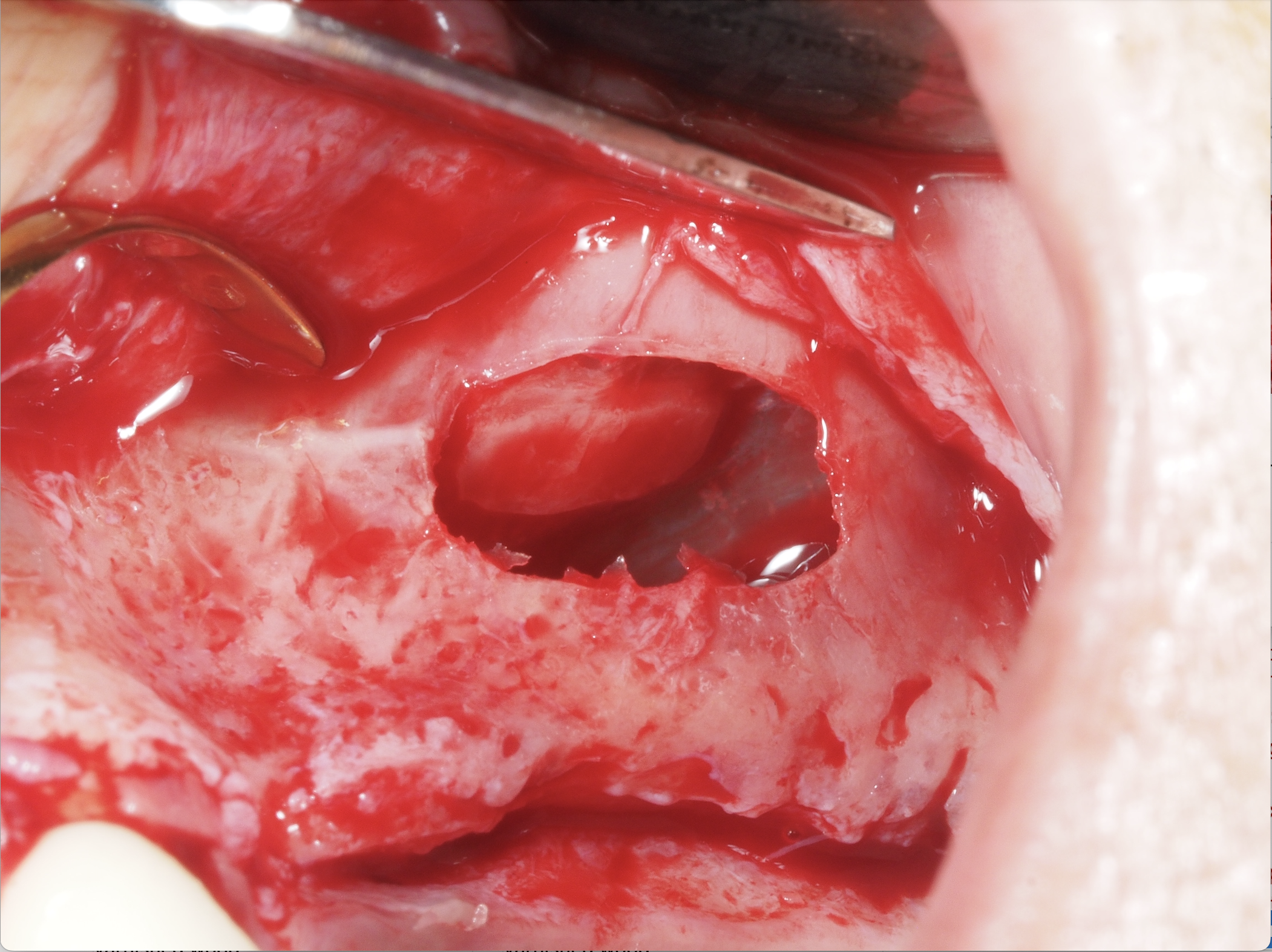 Masterclass : Greffes de Sinus – Sinus Lift et Techniques Avancées de Reconstruction Osseuse